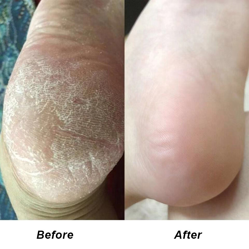 Hautpflege Produkte Fuß Peeling Spray Essenz Pediküre Hand Abgestorbene Haut Peeling Fuß Maske Bleaching Baby Fuß Pflege Männer und frauen