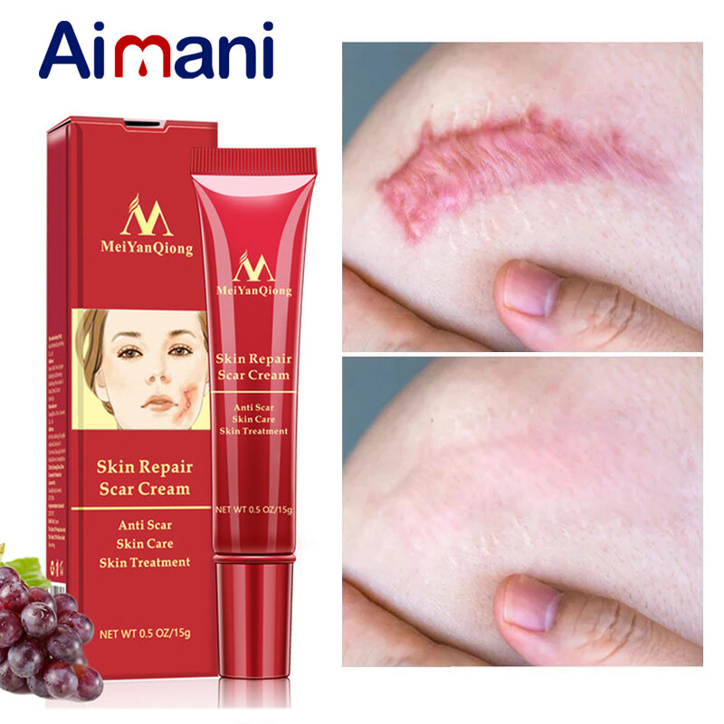Acne cicatriz remoção creme espinhas estrias rosto gel remover acne suavização clareamento cuidados com a pele do corpo pigmentação corrector