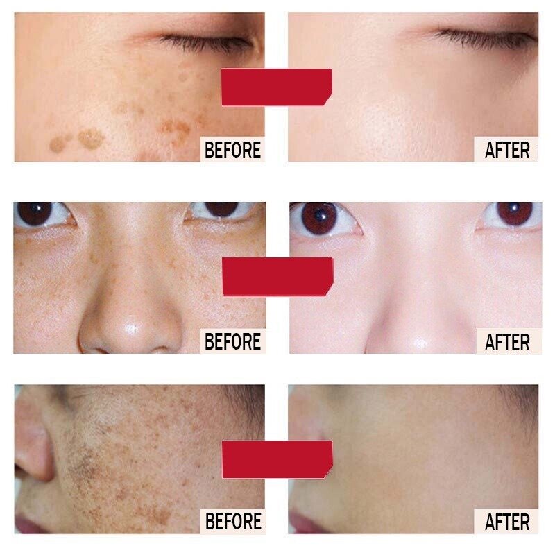 Whitening Freckle Cream Melasma Cream Pekas Remover Dark Spots Remover Brighten Skin Anti-Aging Skin Whitening Cream