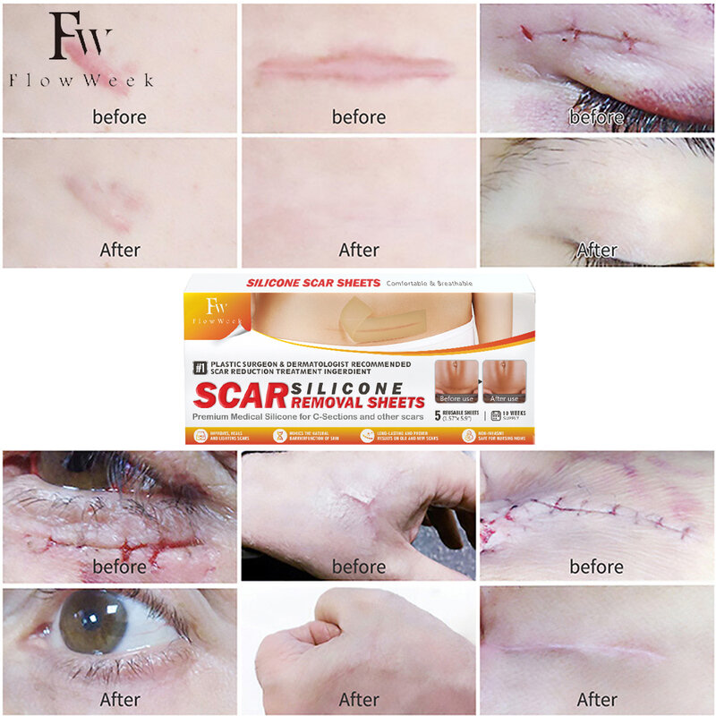 Flow Week-Hojas de silicona para eliminar cicatrices, tiras extralargas para cicatrices quirúrgicas, reparación efectiva