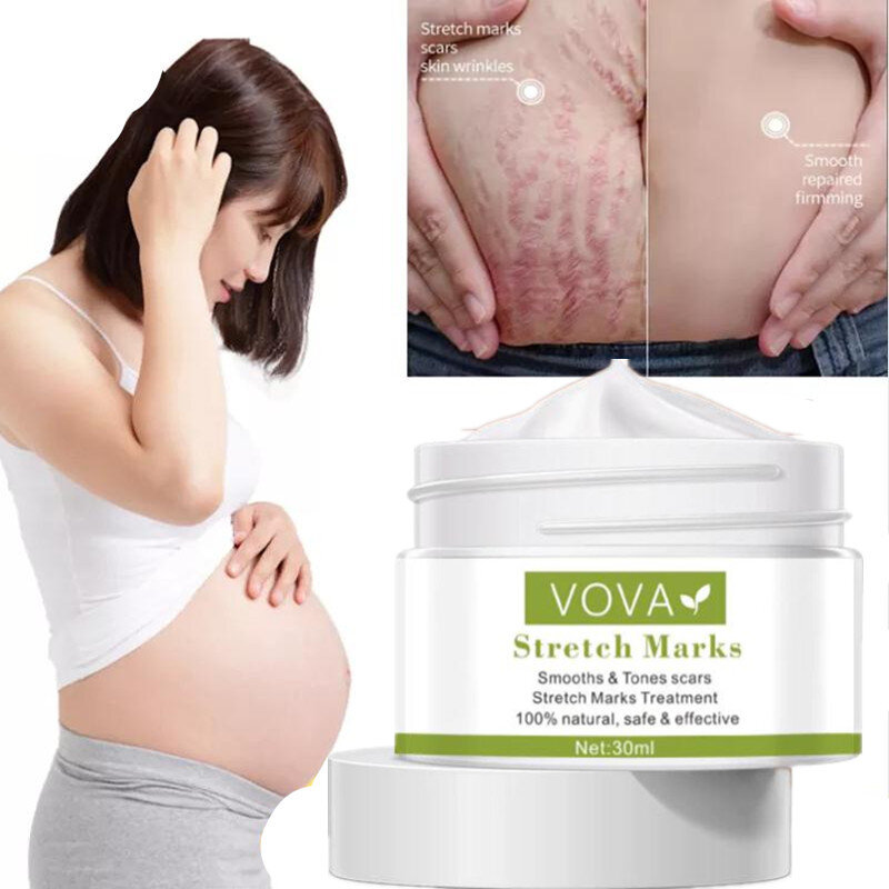 Mujeres embarazadas para eliminar las estrías del cuerpo, glúteos y líneas de pecho, cuidado efectivo de la piel, crema anti-blancas para estrías y cicatrices