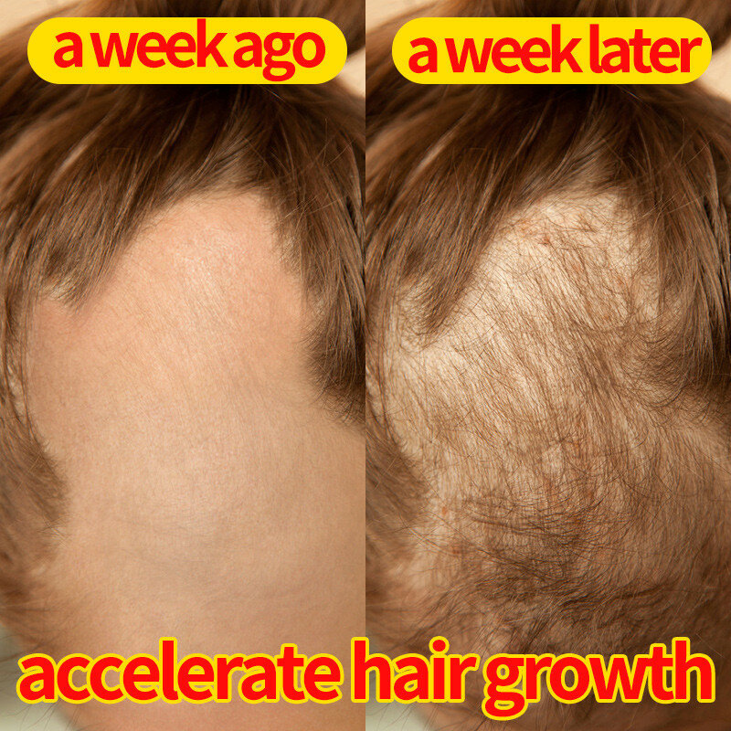Productos para el crecimiento rápido del cabello, aceites esenciales para el crecimiento del cabello, tratamiento anticaída del cabello, reparación eficaz de la calvicie del cuero cabelludo, belleza y salud