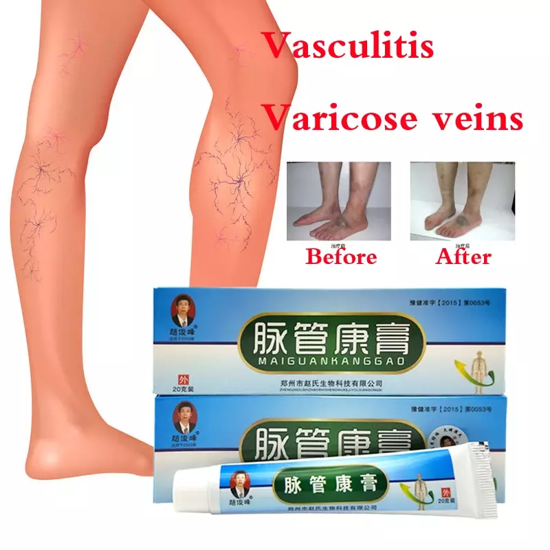Ungüento de hierbas naturales chinas para tratar la inflamación vascular varicosa, crema de masaje para curar las venas varicosas
