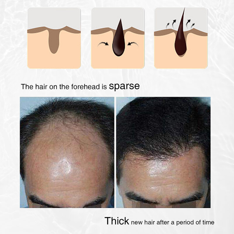 2023 nowy Lanthome cebulowy Spray do wzrostu włosów przeciw utrata włosów dla kobiet ekstrakt z rozmarynu wzmacnia i odżywia odrastanie włosów
