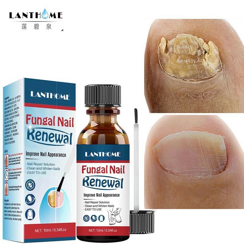 Suero para tratamiento de hongos en las uñas, esencia reparadora de paroniquia, eliminación de hongos en los dedos de los pies, antihongos Gel desinfectante, 3 piezas