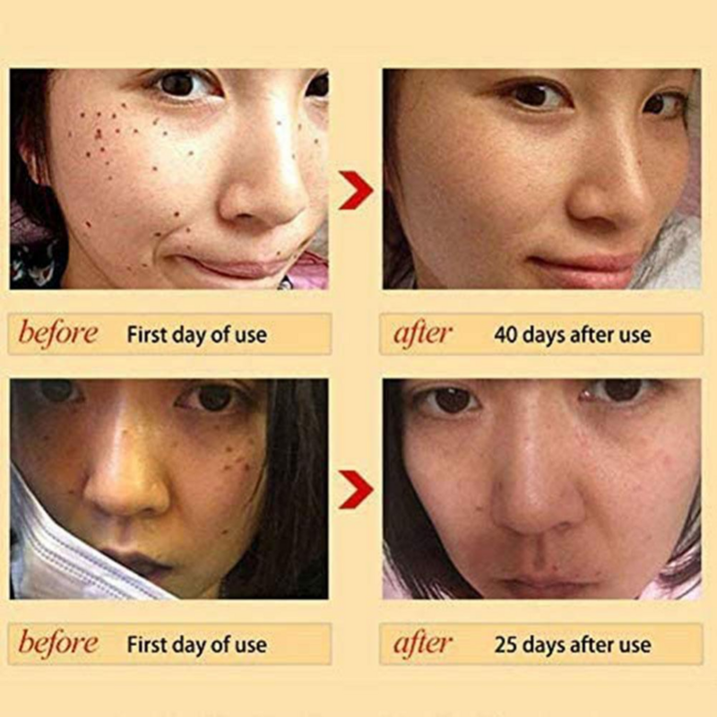 Suero facial blanqueador para el cuidado de la piel, suero facial antiarrugas con ácido hialurónico, eliminación de pecas y acné, esencia de manchas oscuras, 3 piezas