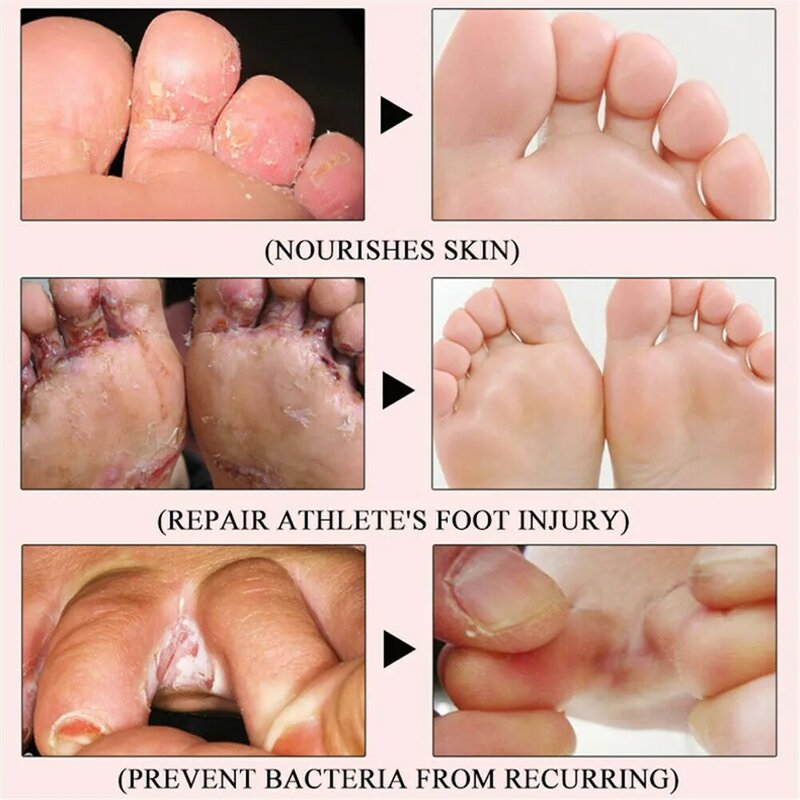 Herba Beriberi Anti-Itch Spray Antifungal Athlete's Foot Itching Cream Toe Lnfections Peeling Treatment Deodorant Feet Care 2PCS