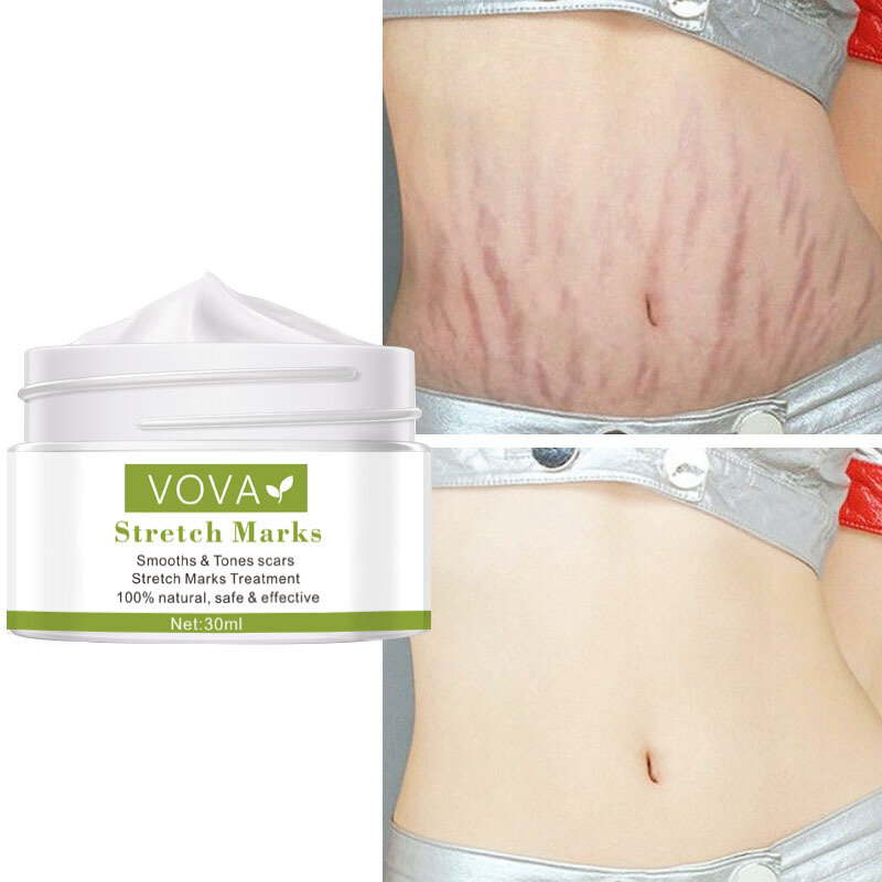 Pregnant Women To Remove Stretch Marks Body Buttocks and Chest Lines Effective Skin Care Anti-white Stretch Marks and Scar Cream