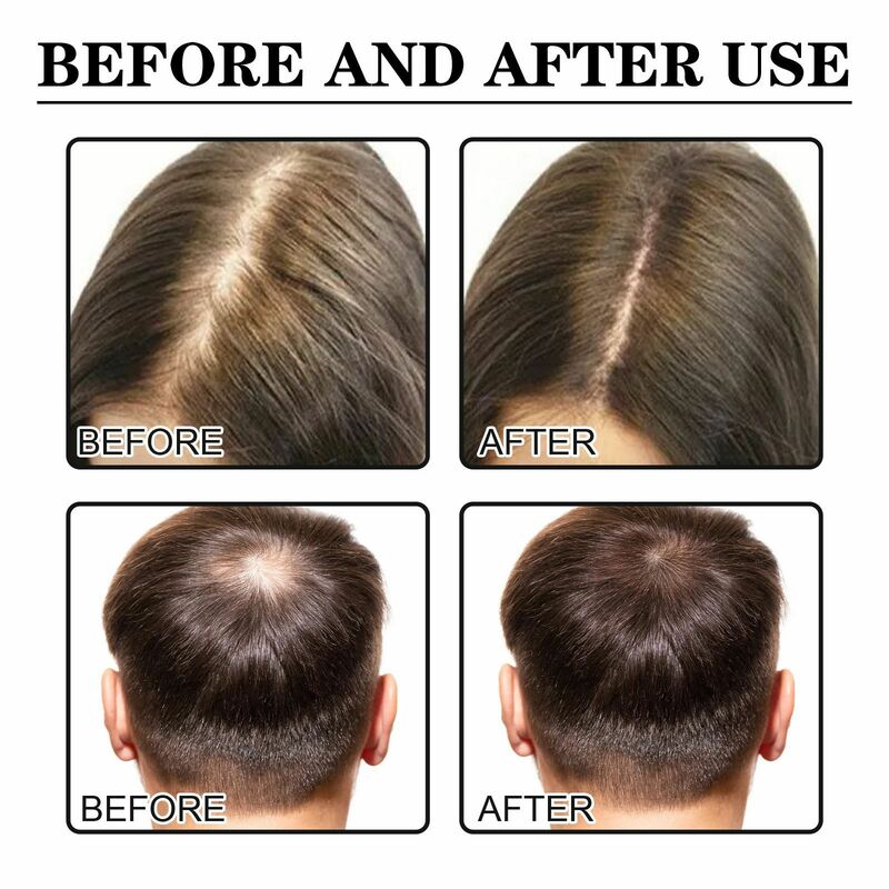 Fast Hair Growth Serum Effective Treatment For Bald Genetic Hair Loss Postpartum Hair Loss Seborrheic Alopecia Bushy Hairline