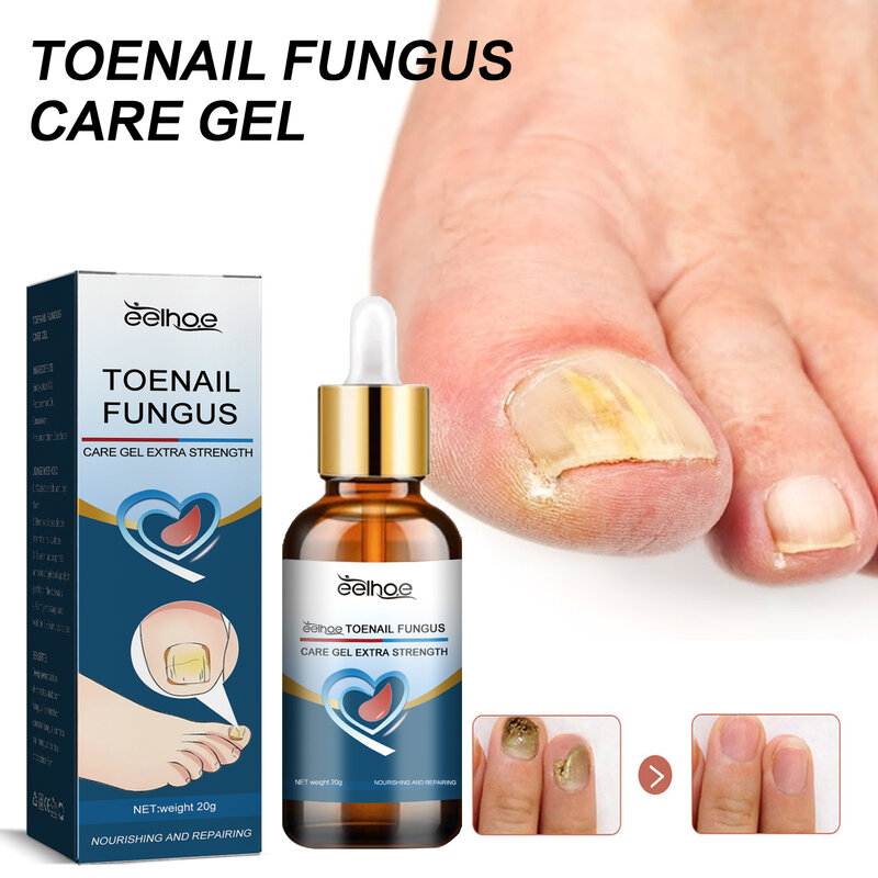 Eelhoe trattamento per unghie olio essenziale sbiancante per mani e piedi rimozione dei funghi delle unghie dei piedi infezione cura dei piedi smalto Gel per unghie