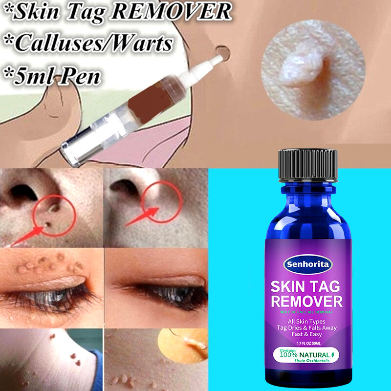 Skin Tag Remover กับ Mole & Genital Wart Fast RemovWithin Al Anti ข้าวโพดกำจัดหูด Papillomas อย่างรวดเร็วกำจัดตุ่น