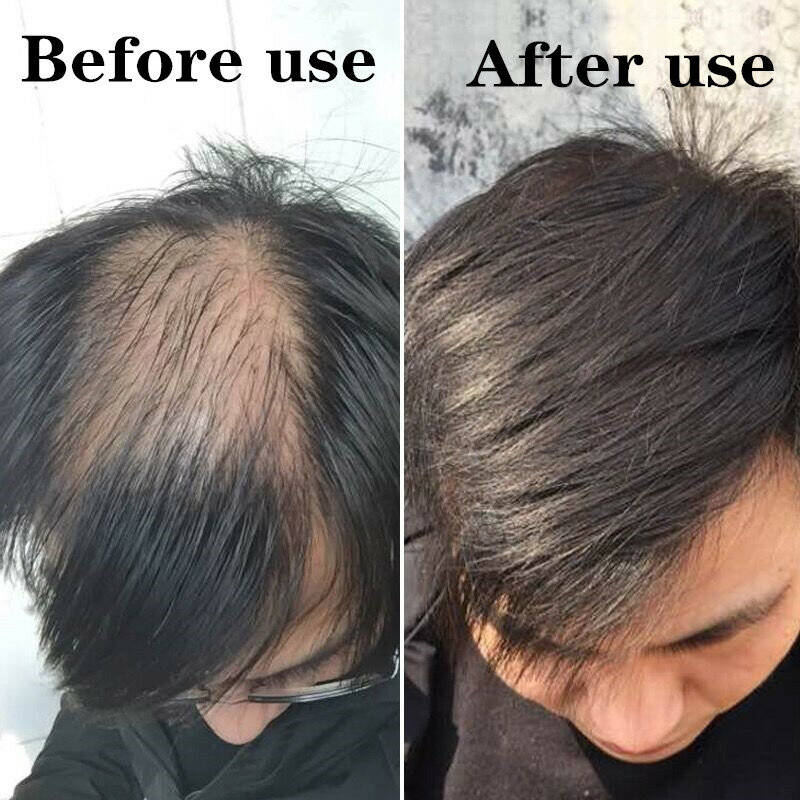 High quality hot sale RU58841 powder PSK3841 HMR3841 99% Anti hair loss Help hair grow  CAS 154992-24-2