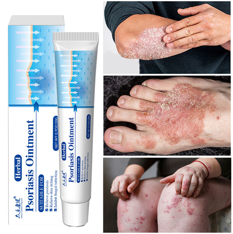 Antibacterial และ Antipruritic CreamPsoriasis CreamHerbal Treatment สำหรับ EczemaRelief Rash โรคลมพิษ Scaling CreamBody Skin Care