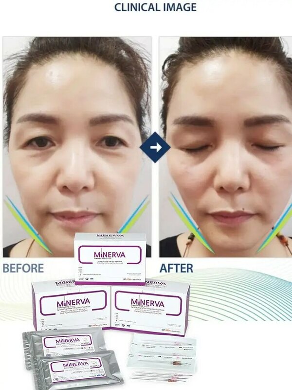 80Pcs เกาหลี Minerva Pdo ด้าย Hilos Tensores Pdo Faciales Mono Smooth Collagen หัวข้อ30G25mm