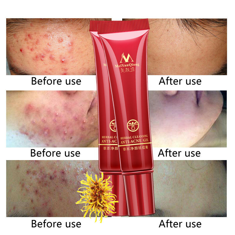 Herbal Cleansing Acne Scar Cream Anti-Acne Treatment Pimples Blains Removal Cream Effectively Control Oil Fade Acne Dark Spots