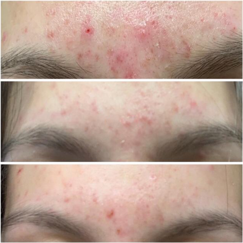 Tea Tree trattamento dell'acne Set per il viso rimuovere efficacemente i punti neri cicatrici da Acne ridurre i pori riparazione siero crema Kit per la cura della pelle prodotto