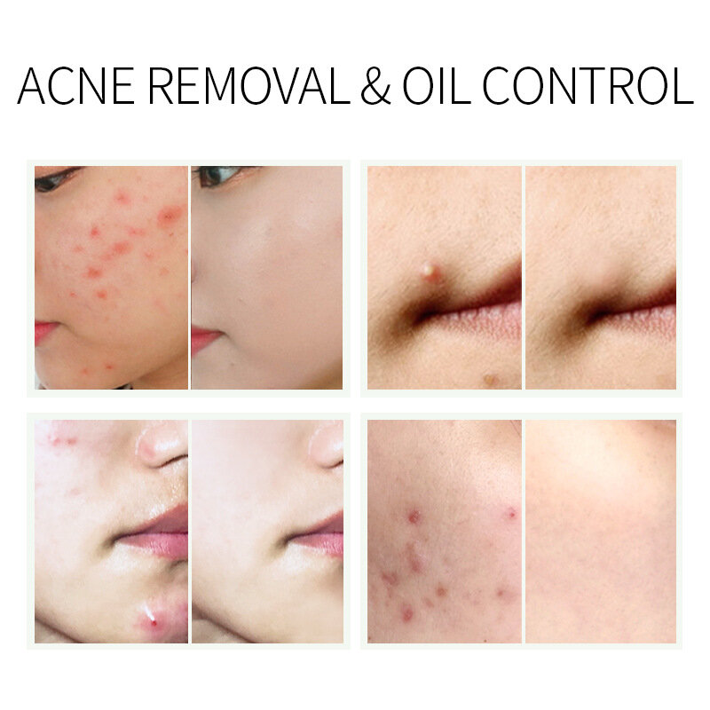 Herbal Acne Cream Repair Nourishing Hydrating Acne Treatment Remove Acne Marks Blackheads Improve Pigmentation Skin Care