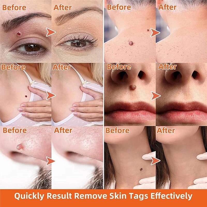 Skin Tags Remover Serum Painless Mole Skin Dark Spot Warts Remover Serum Freckle Face Wart Tag Treatment Removal Essential Oil
