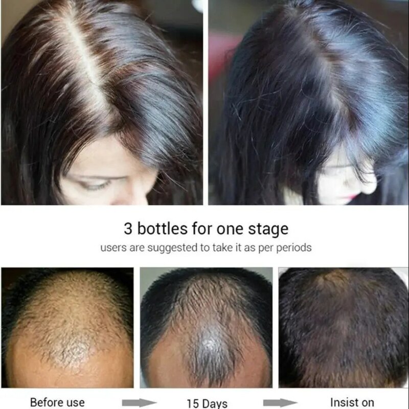 Siero per la crescita dei capelli 3-in-1 Roller Ball Massager nutre i capelli lunghi densi olio essenziale biologico zenzero Anti-caduta dei capelli