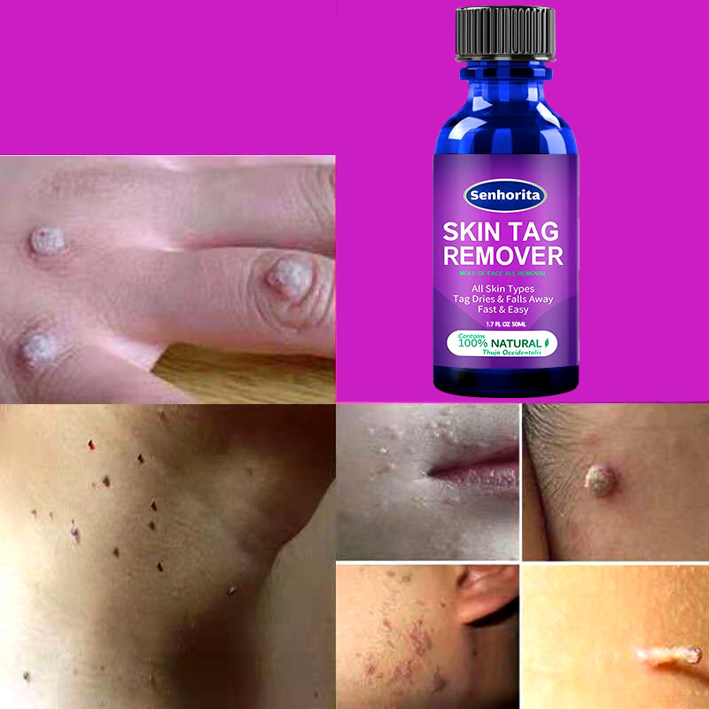 Skin Tag Remover Against Mole & Genital Wart fast RemovWithin al Anti Foot Corn Removal Warts Papillomas Rapidly removes moles