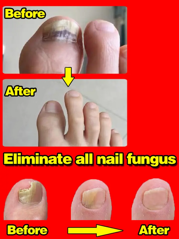 Nail Fungal Treatment Serum Onychomycosis Paronychia Anti Infection Toe Fungus Hand Foot Removal Repair Gel Care Beauty Health