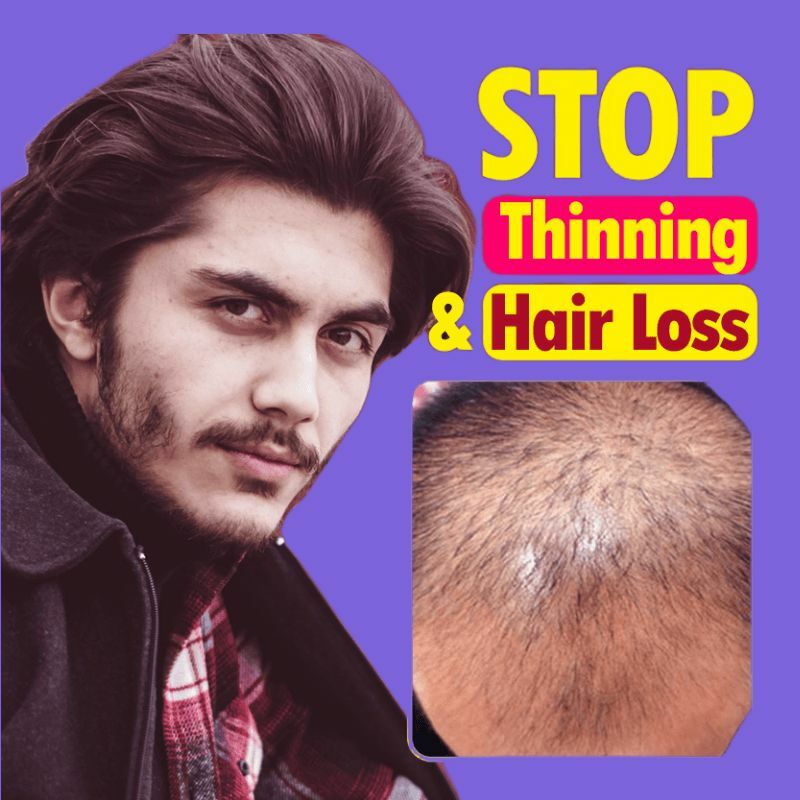 Serum penumbuh rambut cepat, perawatan folikel rambut, pertumbuhan rambut Seborrheic Alopecia, garis rambut setelah melahirkan, mencegah botak