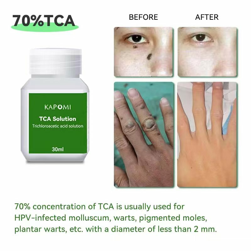 30% 50% 70% Tca пилинг для перекрестной очистки кожи, кислотная кожа, супер сила, желтое пилинг, пигментация, шрамы от акне