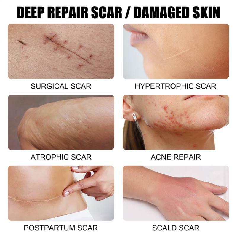 Suero reparador de cicatrices para el cuidado de la piel, tratamiento para el acné, eliminación de marcas de estiramiento, blanqueamiento posparto, 30/50ml