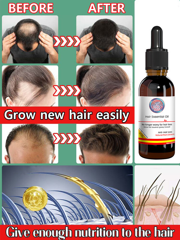 Aceite para el crecimiento rápido del cabello, reparación eficaz de la calvicie, pérdida de cabello postparto, pérdida de cabello seborreica