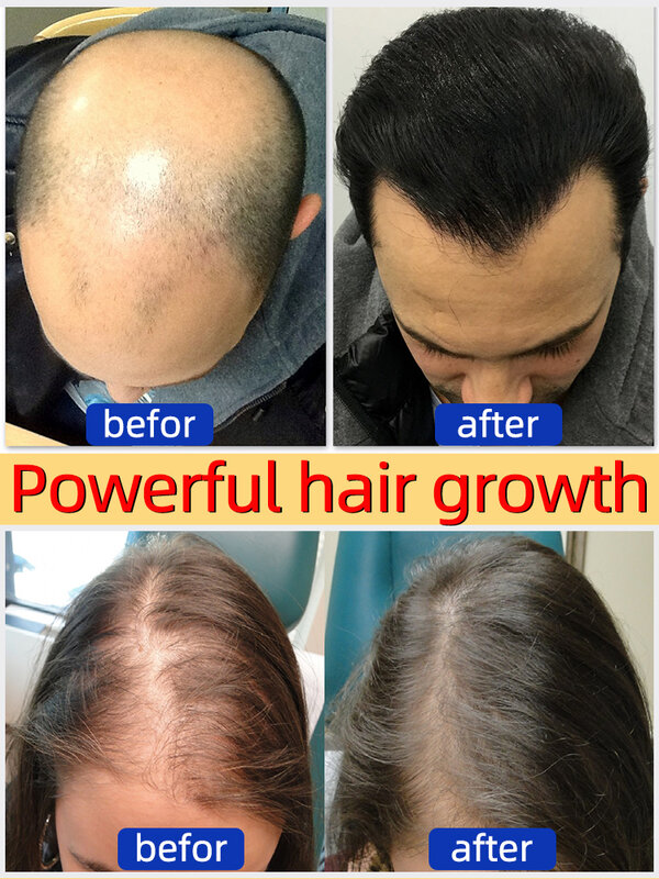 Potente suero para el crecimiento del cabello, tratamiento Anti pérdida de cabello, crecimiento rápido del cabello, Alopecia seborreica, línea de cabello, folículo capilar, cuidado saludable