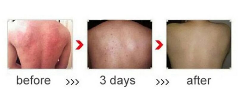 Eczema-治療用ライトニングクリーム,皮膚炎炎クリーム,新品