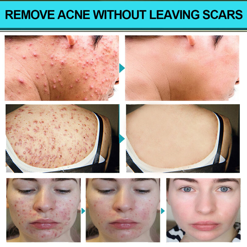 Spray de eliminación de acné y ácido salicílico, espinillas, cicatrices, espinillas, tratamiento para manchas oscuras, encoge los poros, hidrata, blanquea, cuidado corporal