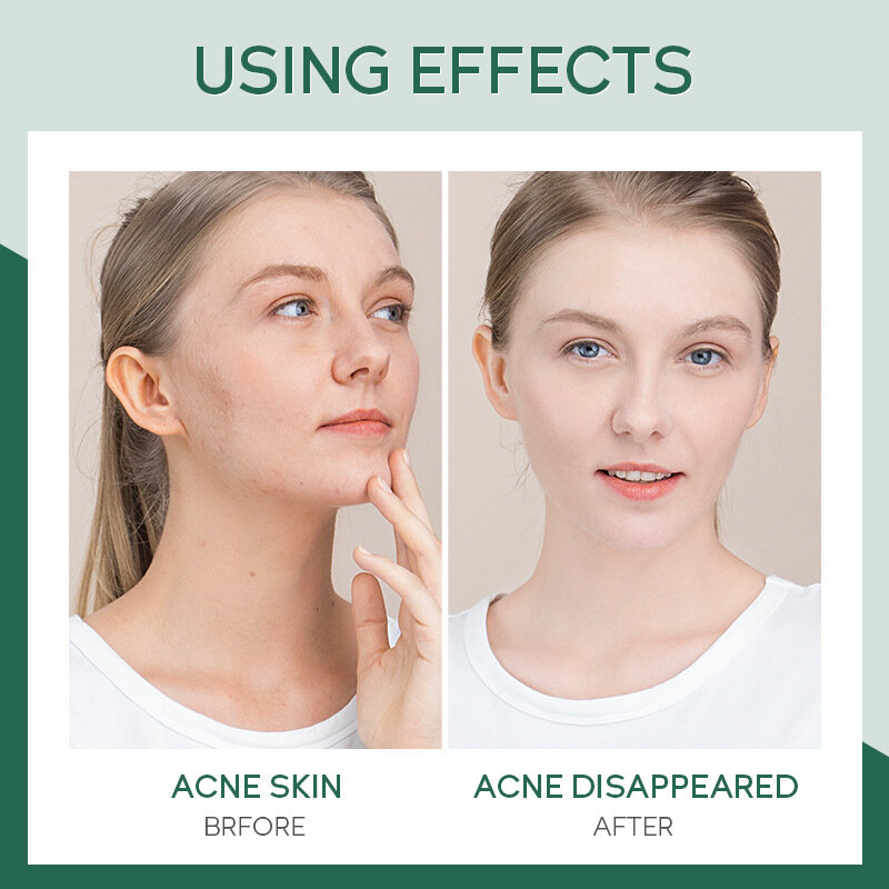 Akne Serum pflegende Reparatur feuchtigkeit spendende Akne-Behandlung reduziert Akne-Markierungen beruhigende schrumpfende Poren Öl Kontrolle Hautpflege