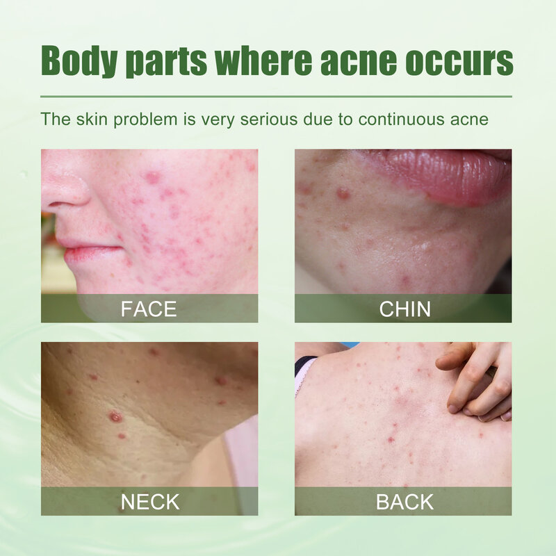 Acne remoção gel tratamento clarear acne marcas melhorar acne pits controle de óleo clareamento hidratante rosto limpo gel cuidados com a pele