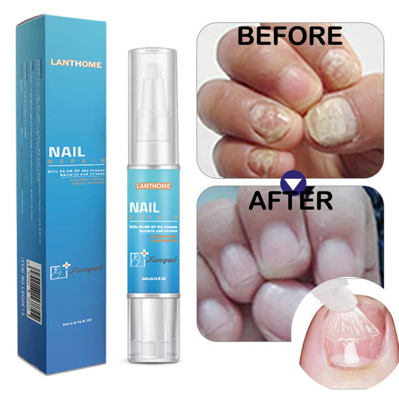 Nail Fungal Treatment Essence Pen Anti Infection Paronychia Onychomycosis Nail Foot Toenail Fungus Removal Gel Feet Care Product