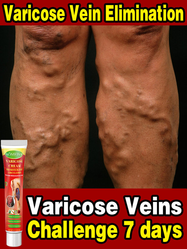 Effective Varicose Vein Relief Cream Ointment For Varicose Veins To Relieve Vasculitis Phlebitis Spider Pain Treatment