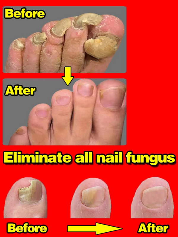 Serum perawatan jamur kuku onikomikosis Paronychia Anti infeksi jamur kaki tangan memperbaiki Gel perawatan kesehatan kecantikan