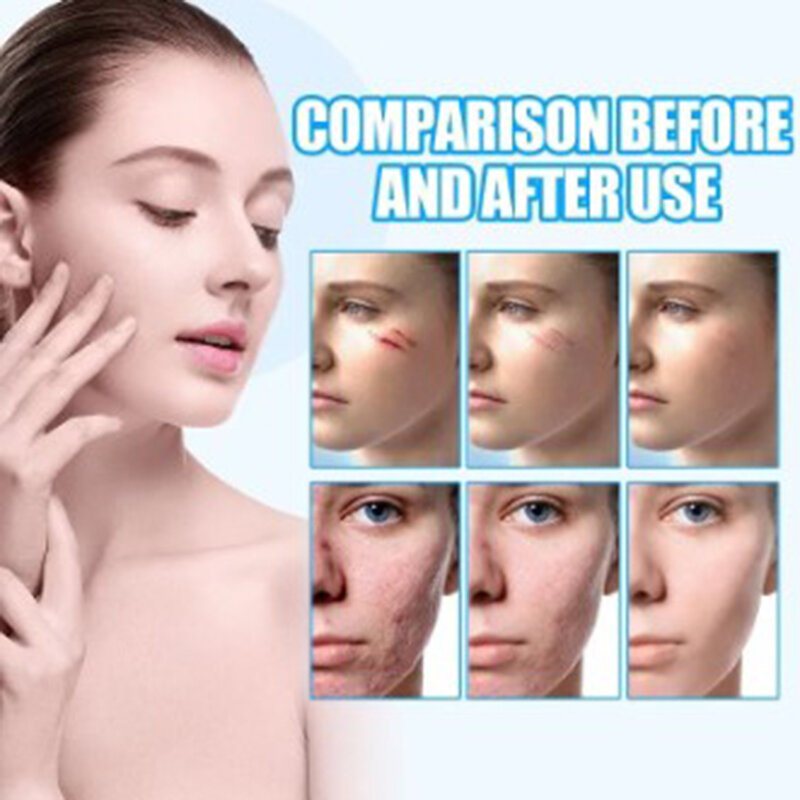 Gel de eliminación de cicatrices Flow Week-Tratamiento de manchas y cicatrices de acné para la cara, Gel para cicatrices de rejuvenecimiento facial, cuidado de la piel suave para la piel sensible propensa al acné