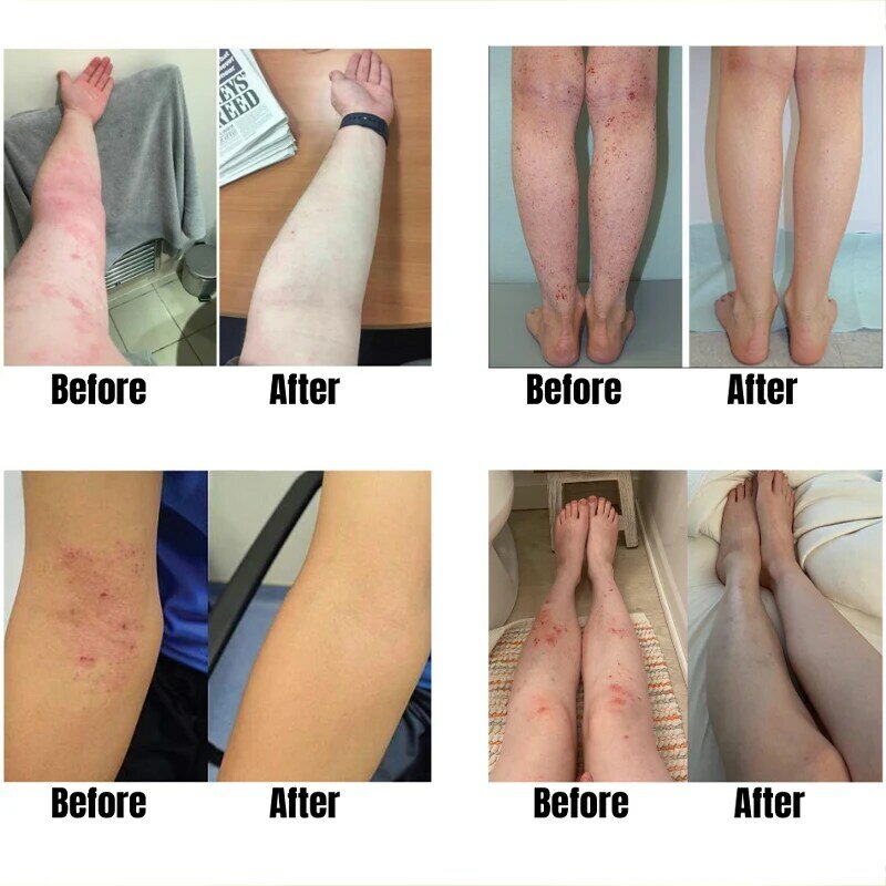 Hautpflege Produkte Effektive Anti-Juckreiz Psoriasis Antibakterielle Creme Dermatitis Eczematoid Salbe 15g