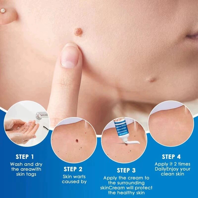 Skin Tag Remover Essential Oil Painless Mole Skin Dark Spot Warts Remover Serum Freckle Face Wart Tag Treatment Removal Cream