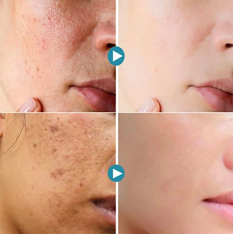 Glutathione Freckle Remover Serum Dark Spots Acne Removal  Face Niacinamide Whitening Products Vitamin C Brighten Facial Essence