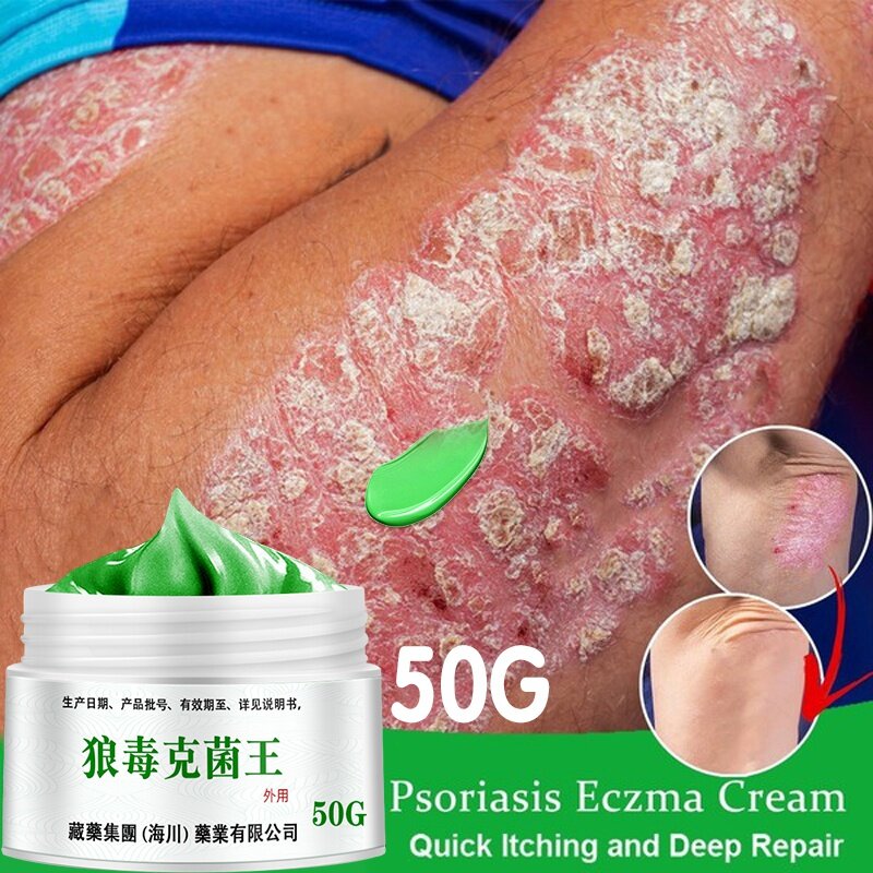 50G โรคสะเก็ดเงินโรคผิวหนัง Eczematoid กลากครีม Anti-Itch สมุนไพรจีน Medical Skin Care ครีม