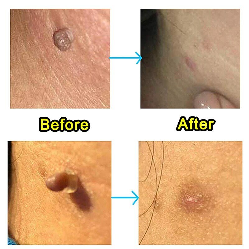 Skin Tag Remover Genital Wart Treatment Instant Removal Mole & Papillomas ข้าวโพดซ่อมเครื่องมือธรรมชาติ Bacteriostatic Liquid