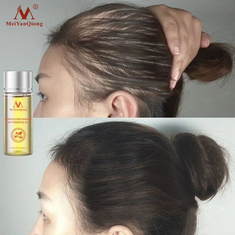 Potente olio per la crescita dei capelli prevenire i prodotti per la perdita dei capelli essenza trattamento liquido per uomini e donne riparazione Shampoo cura dei capelli 20ml