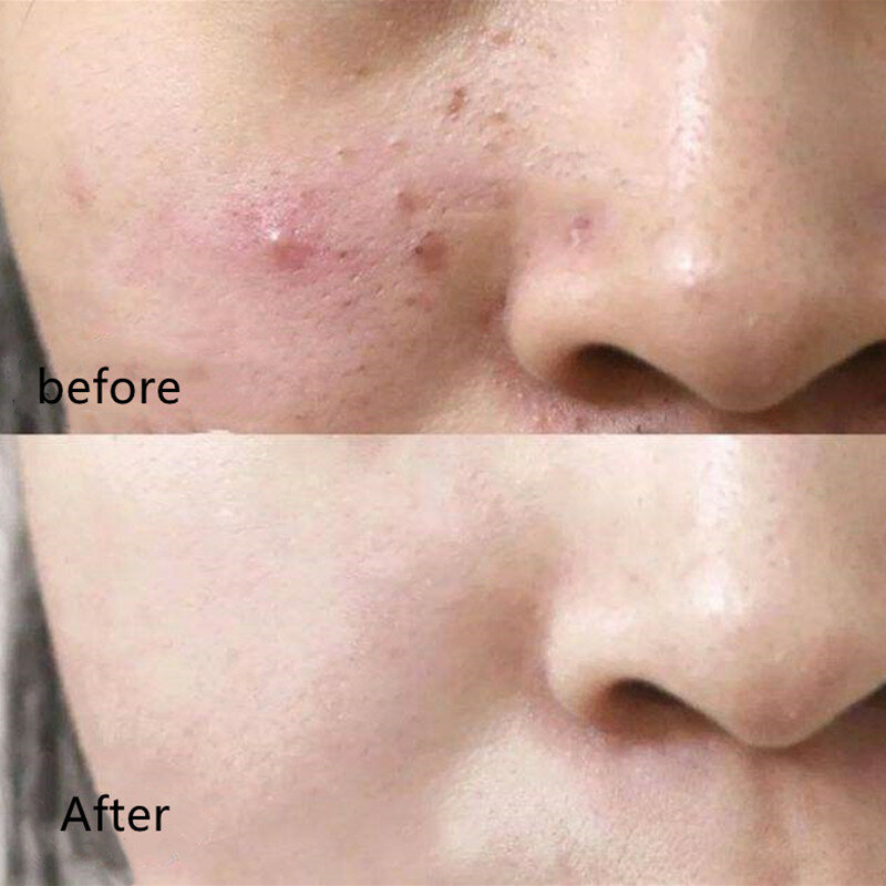 Tratamento da acne da árvore do chá conjunto facial efectively remover cravos acne cicatrizes encolher poros reparação soro creme cuidados com a pele kit produto