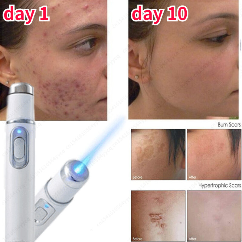 Voor dropshipping acne laser pen draagbare rimpel verwijdering machine duurzaam zacht litteken verwijderaar apparaat blauw licht therapie pen massage