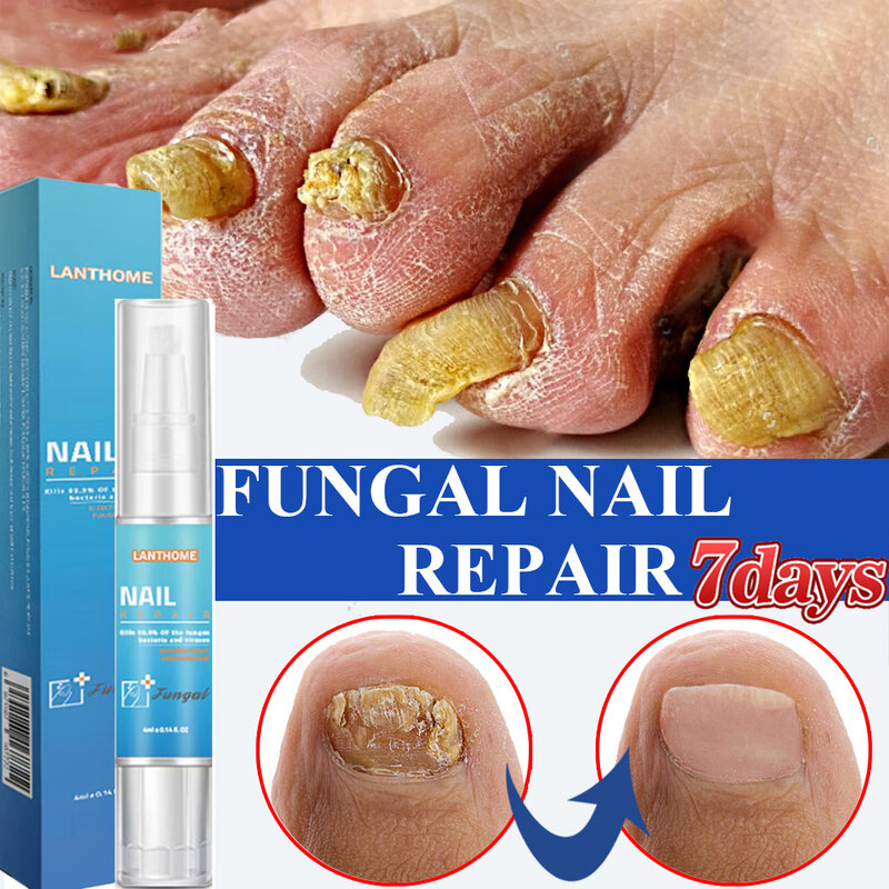 Nail Fungal Treatment Essence Pen Anti Infection Paronychia Onychomycosis Nail Foot Toenail Fungus Removal Gel Feet Care Product