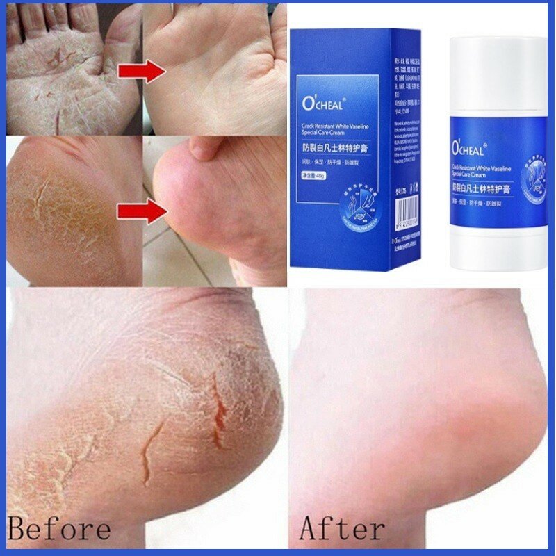 Ocheal Anti-Drying Crack Foot Cream Hand Heel Cracked Repair Cream Removal Dead Skin Foot Mask Moisturizing Hand Feet Care 40g