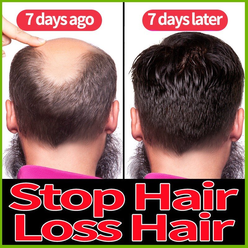 Aceite de esencia efectivo para el crecimiento del cabello, suero de crecimiento rápido del cabello, tratamiento de reparación líquida anticaída de cabello, folículos Dens, línea de cabello fuerte