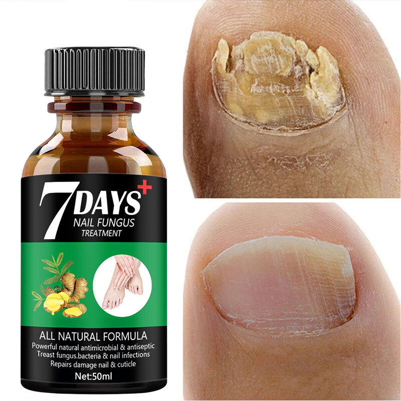 Soro do tratamento fúngico do prego do soro do reparo do prego onychomycosis paronychia anti-infecção fúngica do prego do dedo do pé do pé do fungo reparação cuidados